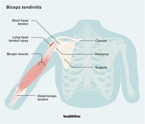 arm esk tebov|Biceps/Triceps tendon injuries